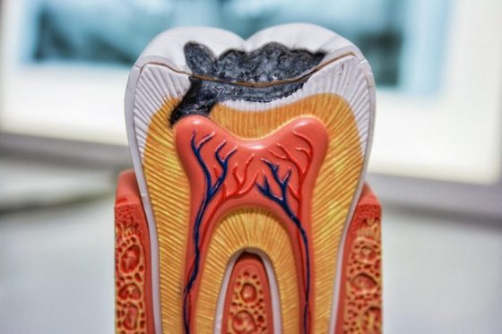 Modell eines Zahns mit Karies. Foto: Sonja Trabandt