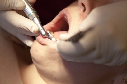 Nahaufnahme eines geöffneten Mundes in den zwei Hände in Gummihandschuhen zahnmedizinische Instrumente hinein halten.